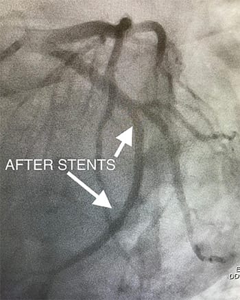 Cardiology and Interventional Cardiology After Stent 1