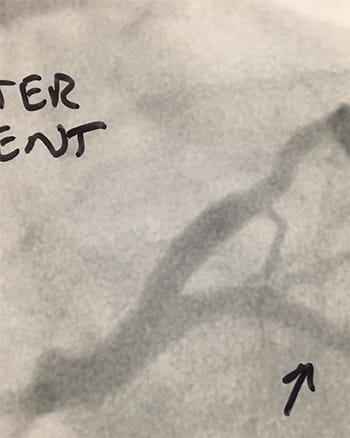 Cardiology and Interventional Cardiology After Stent