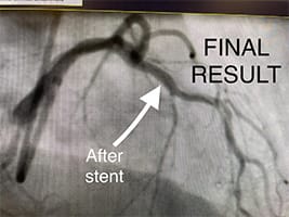 Cardiology and Interventional Cardiology After Stent Result
