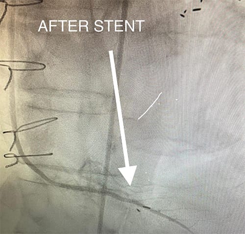 Cardiology and Interventional Cardiology Anastamotis - After
