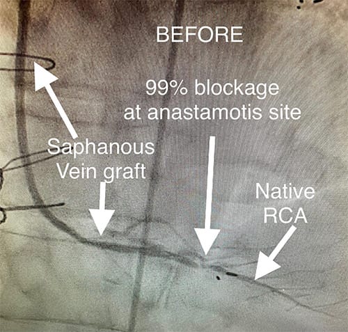 Cardiology and Interventional Cardiology Anastamotis - Before