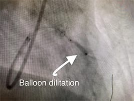 Cardiology and Interventional Cardiology Balloon Dilitation