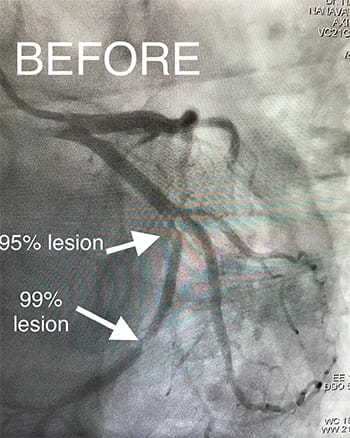 HeartCare4life, Dr. Vimal Nanavati, Board Certified in Cardiology and Interventional Before Stent