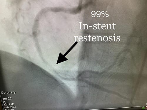 Cardiology and Interventional In Stent Restenosis