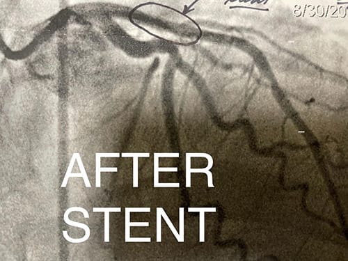 Cardiology and Interventional Cardiology LAD Lesion - After
