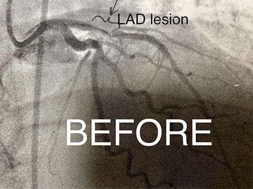 Cardiology and Interventional Cardiology LAD Lesion - Before
