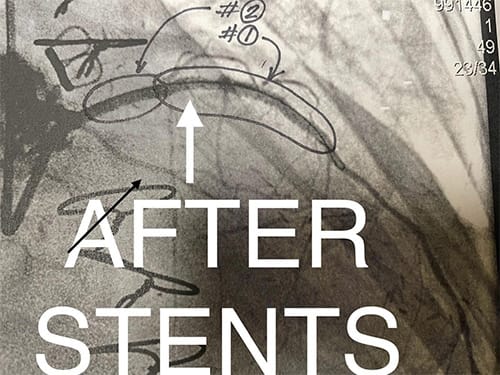 Cardiology and Interventional Cardiology LAD Stenosis - After