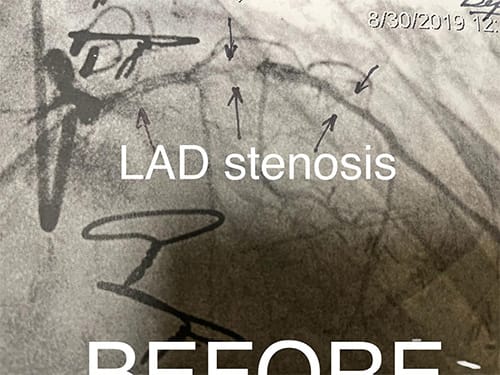 Cardiology and Interventional Cardiology LAD Stenosis - Before