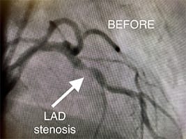 Cardiology and Interventional Cardiology Lad Stenosis - Before