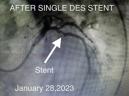 HeartCare4life, Cardiology and Interventional Cardiology LCX Lesion - After