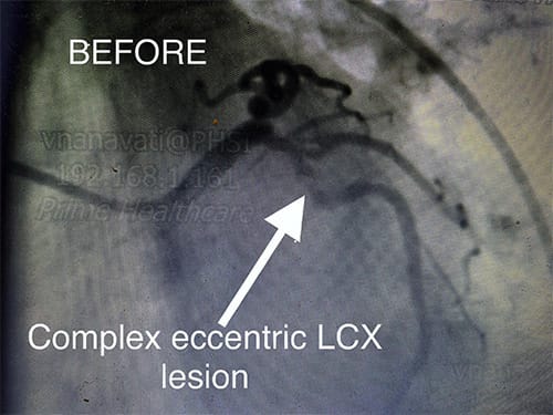 HeartCare4life, Cardiology and Interventional LCX Lesion - Before