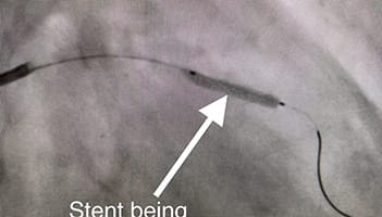 Cardiology and Interventional Cardiology Left Anterior - After1