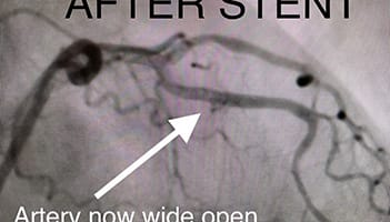 Cardiology and Interventional Cardiology Left Anterior - After2
