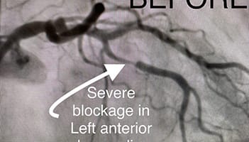 Cardiology and Interventional Cardiology left Anterior - Before