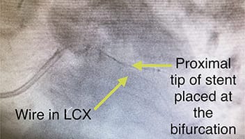 Cardiology and Interventional Cardiology LAD Lesion - Befor2