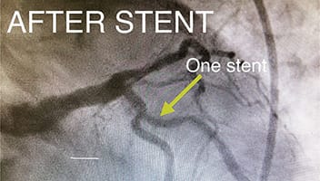 Cardiology and Interventional Cardiology LAD Lesion - Befor3