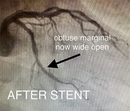 Cardiology and Interventional Cardiology Obtuse Marginal Block - After