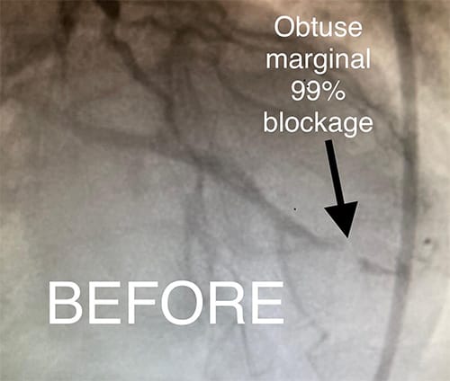 Cardiology and Interventional Cardiology Obtuse Marginal Block - Before