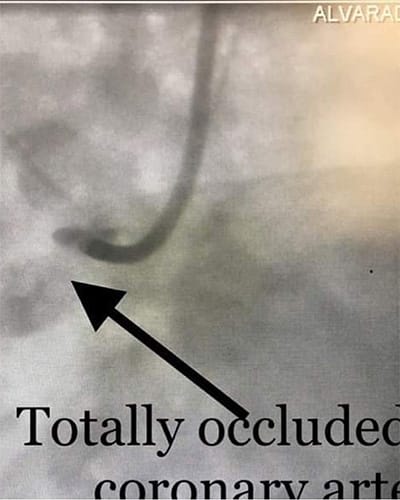 Cardiology and Interventional Occluded Artery