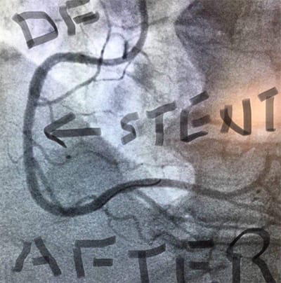 Cardiology and Interventional Cardiology DF Stent After