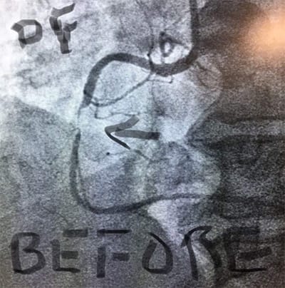 Cardiology and Interventional DF Stent Beforfe