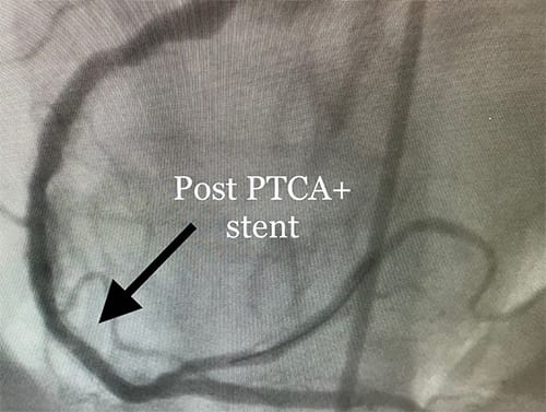 Cardiology and Interventional Cardiology Post PTCA Stent