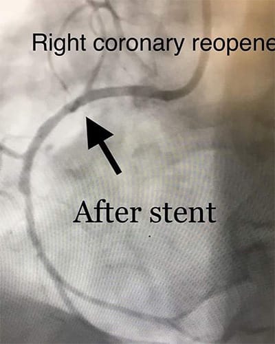 Cardiology and Interventional Cardiology Right Coronary Reopened1