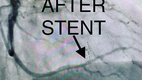 Cardiology and Interventional Cardiology Stenosis - After