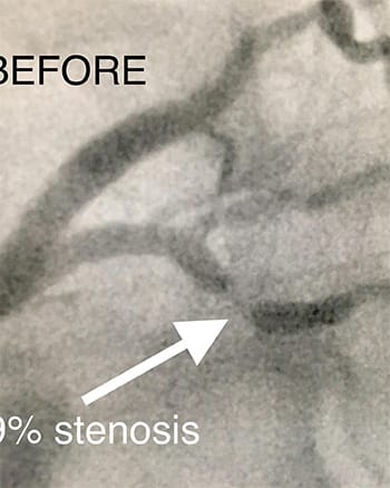 Cardiology and Interventional Before Stent