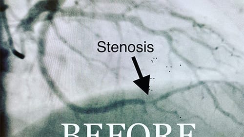 Cardiology and Interventional Cardiology Stenosis - Before