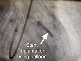 Cardiology and Interventional Cardiology Stent Implantation Balloon