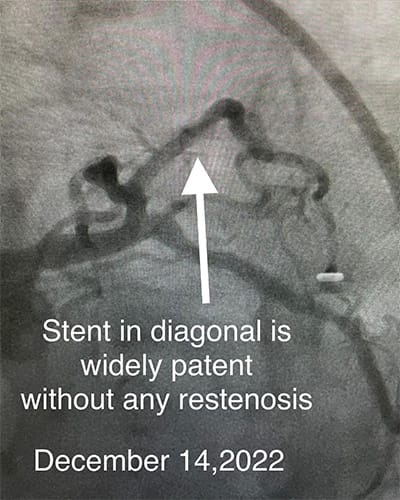 HeartCare4life, Cardiology and Interventional Cardiology Stent Without Restenosis